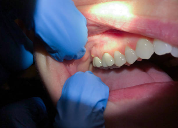 Best Emergency Dentist for Lost Fillings or Crowns in Bnchard, LA